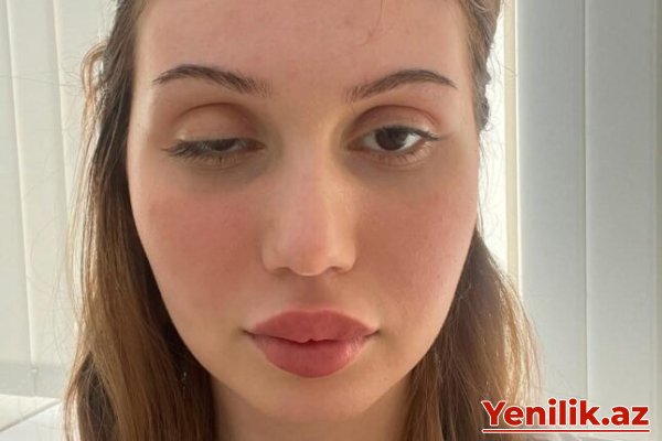 Botoks etdirən qadının üzü bu hala düşdü – Foto