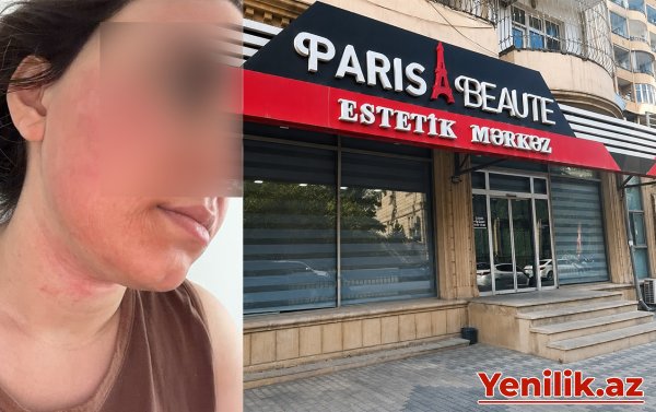 “Lazeroloq üzümü yandırıb...” - Foto